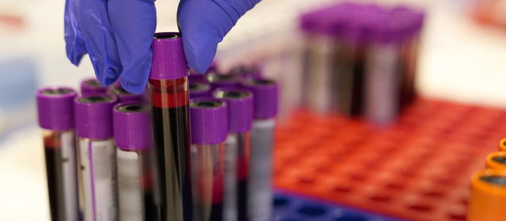 Neuer Bluttest weckt Hoffnung auf Früherkennung bei Bauchspeicheldrüsenkrebs